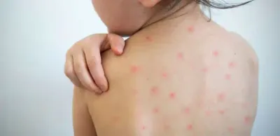 Казахстанцы не знают насколько опасна корь – эксперт