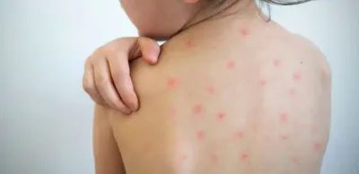 Подробности смерти двух детей от кори в Казахстане назвали в Минздраве